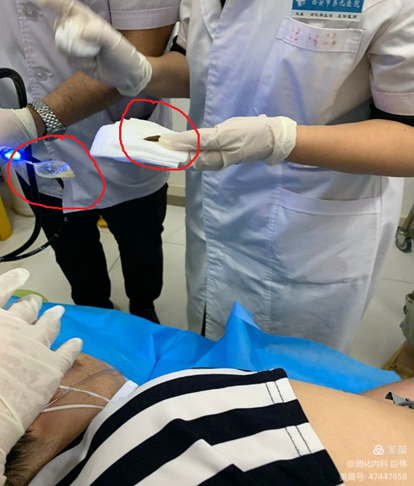 网篮在异物取出术中的应用 网篮在异物取出术中的应用