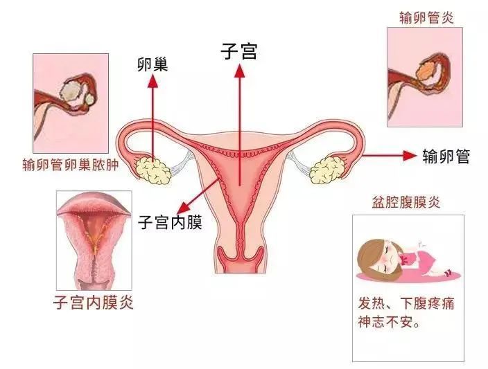 【科普园地】盆腔炎那些你不知道的事 【科普园地】盆腔炎那些你不知道的事