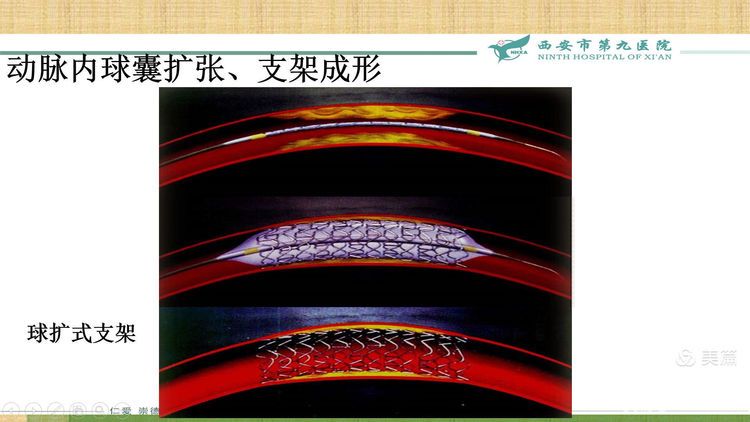 【特色技术】神经外科——球囊扩张及支架成形术治疗颅内动脉粥样硬化性狭窄(ICAS) 【特色技术】神经外科——球囊扩张及支架成形术治疗颅内动脉粥样硬化性狭窄(ICAS)