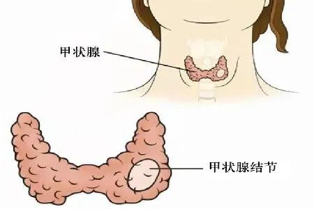 “甲状腺细针穿刺活检”真的那么可怕么？
