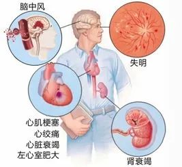 【健康科普】高血压患者不可“任性”停药