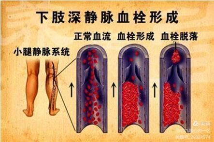 长途飞行会发生下肢深静脉血栓吗? 长途飞行会发生下肢深静脉血栓吗?