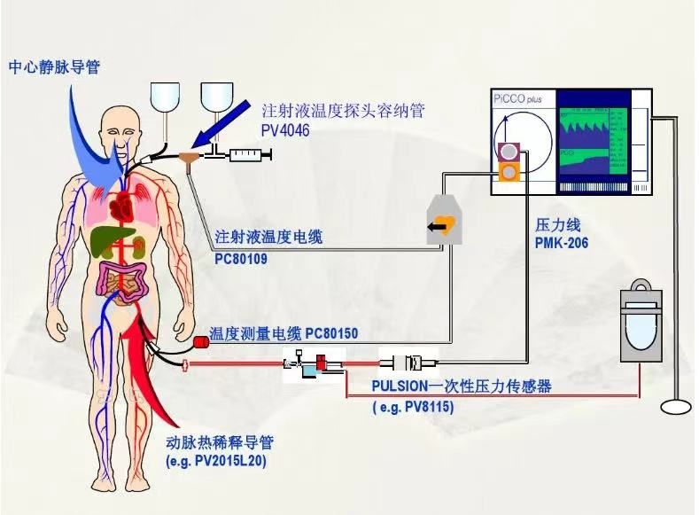 链接心肺的桥梁—PiCCO | PiCCO助力年轻生命重返校园 链接心肺的桥梁—PiCCO | PiCCO助力年轻生命重返校园