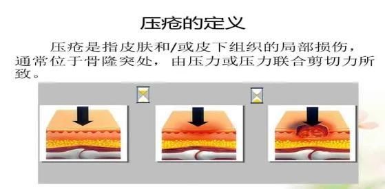 压疮的预防 压疮的预防