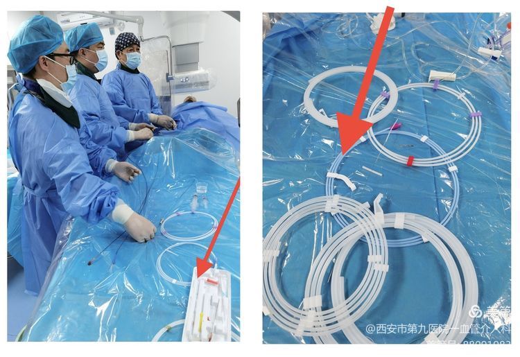 【血管介入科 】介入术中耗材保护的创新与临床应用 【血管介入科 】介入术中耗材保护的创新与临床应用