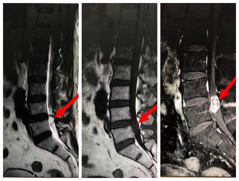 【神经肿瘤】神经电生理监测下切除椎管内肿瘤 【神经肿瘤】神经电生理监测下切除椎管内肿瘤
