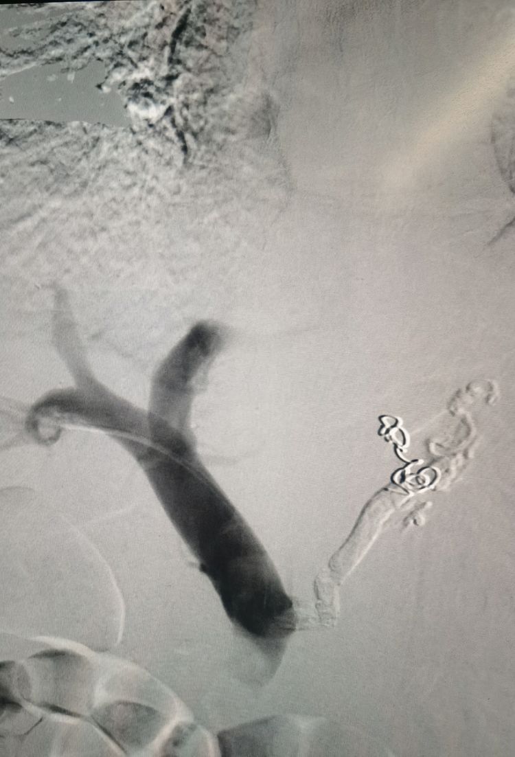 血管介入科救治一例肝硬化所致上消化道大出血患者 血管介入科救治一例肝硬化所致上消化道大出血患者