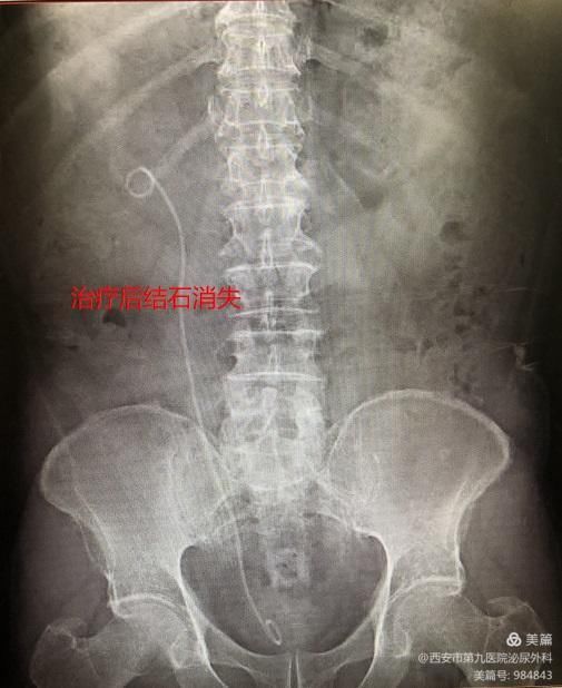 【泌尿外科】一次性电子输尿管软镜治疗上尿路结石 【泌尿外科】一次性电子输尿管软镜治疗上尿路结石