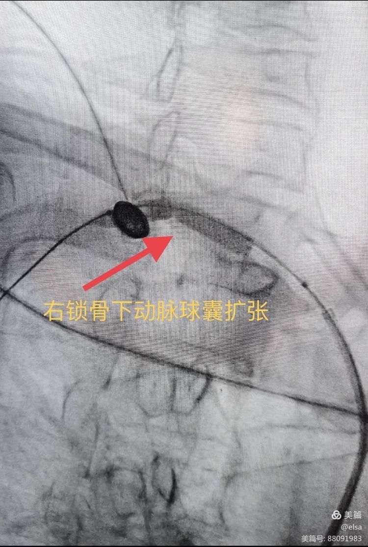 锁骨下动脉盗血症 锁骨下动脉盗血症