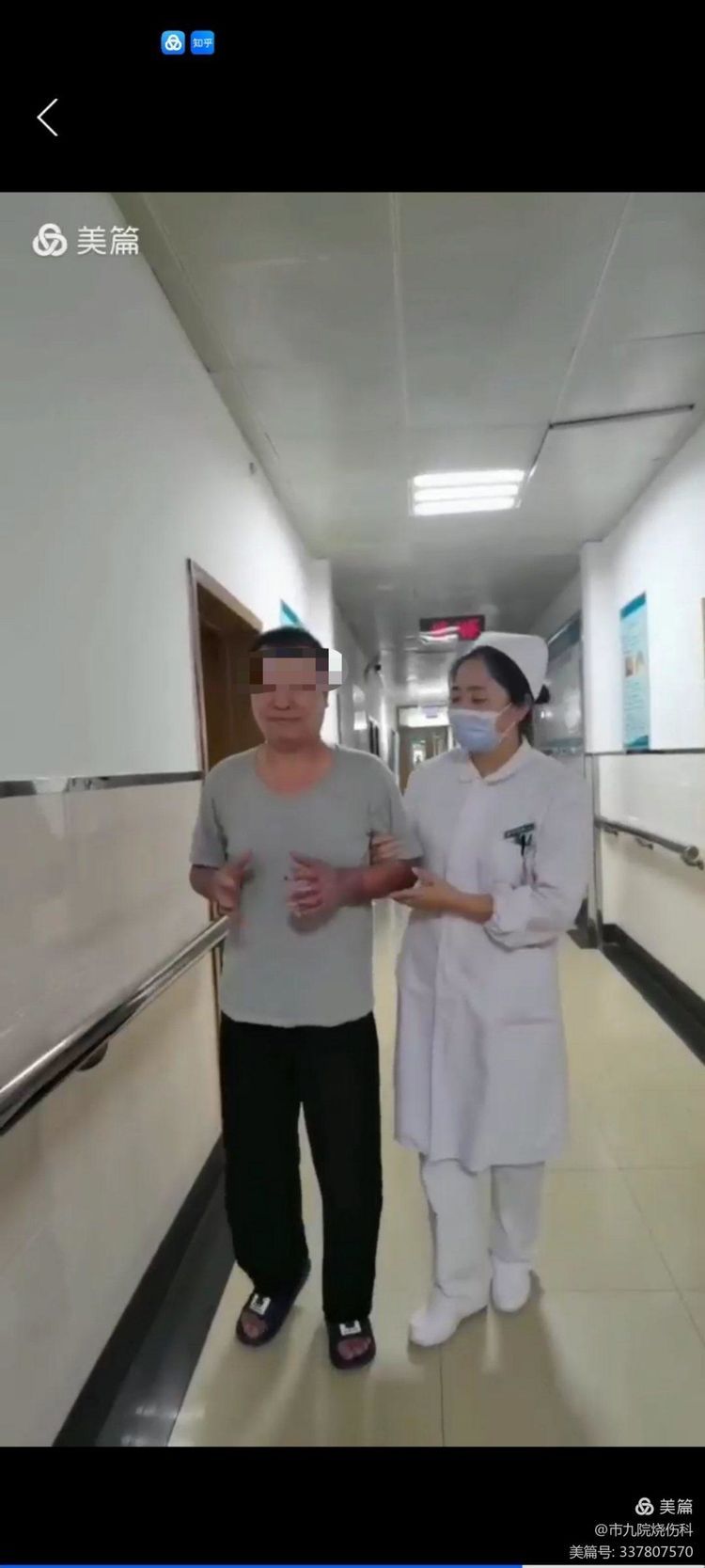 烧伤整形科治愈1例烧伤面积80%合并烧伤脓毒症重症患者 烧伤整形科治愈1例烧伤面积80%合并烧伤脓毒症重症患者