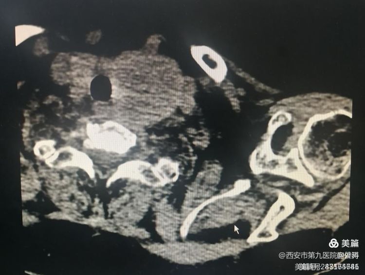 微波消融在甲状腺结节治疗的应用 微波消融在甲状腺结节治疗的应用