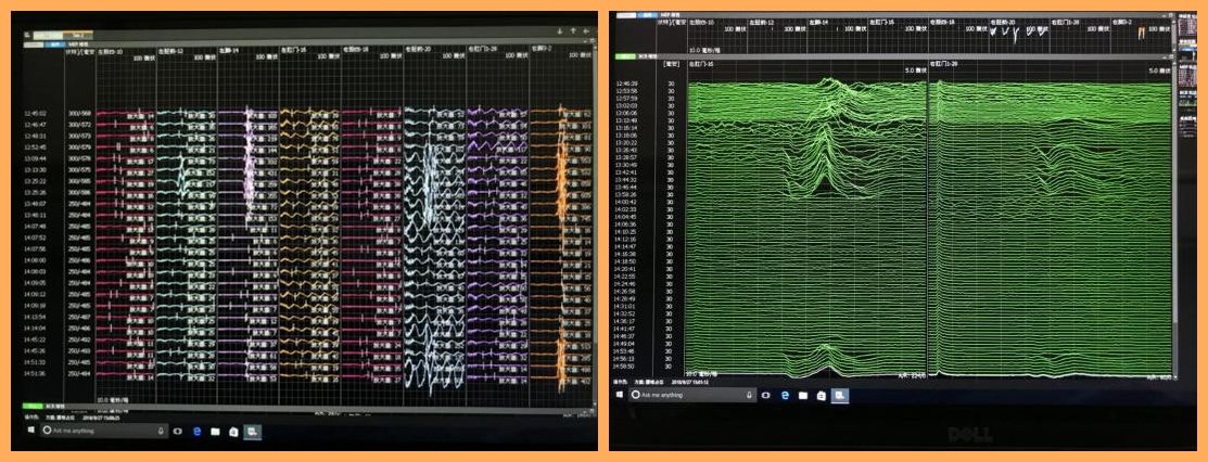【神经肿瘤】神经电生理监测下切除椎管内肿瘤 【神经肿瘤】神经电生理监测下切除椎管内肿瘤