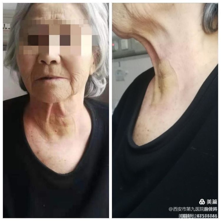 微波消融在甲状腺结节治疗的应用 微波消融在甲状腺结节治疗的应用