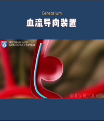 特色展示之九-血流导向装置在颅内复杂动脉瘤中的应用 特色展示之九-血流导向装置在颅内复杂动脉瘤中的应用