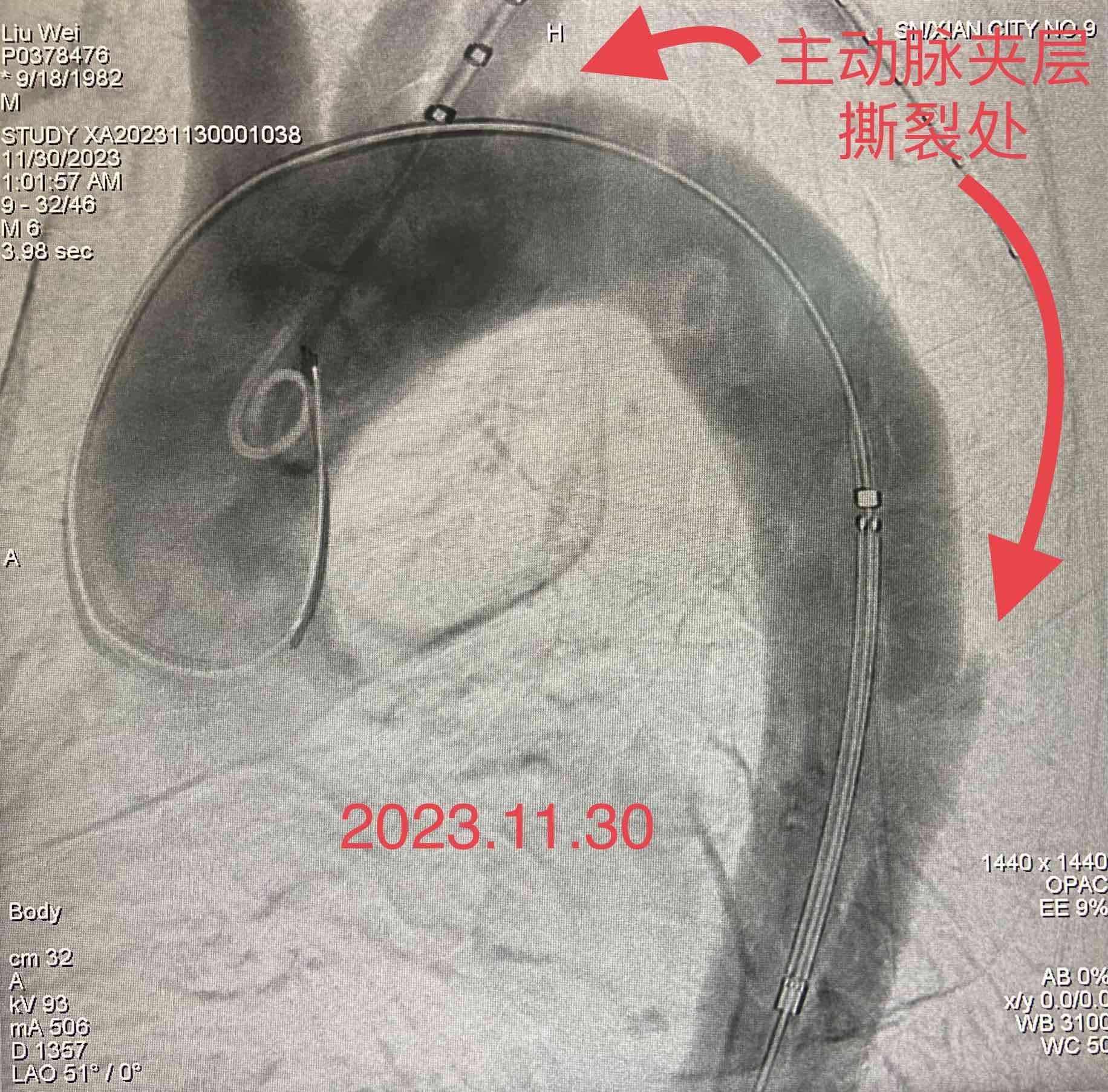 一例急性主动脉夹层患者就诊记 一例急性主动脉夹层患者就诊记
