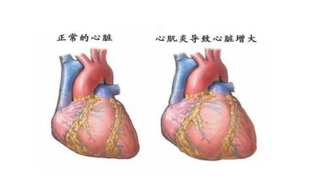 心肌炎患者应该注意什么? 心肌炎患者应该注意什么?