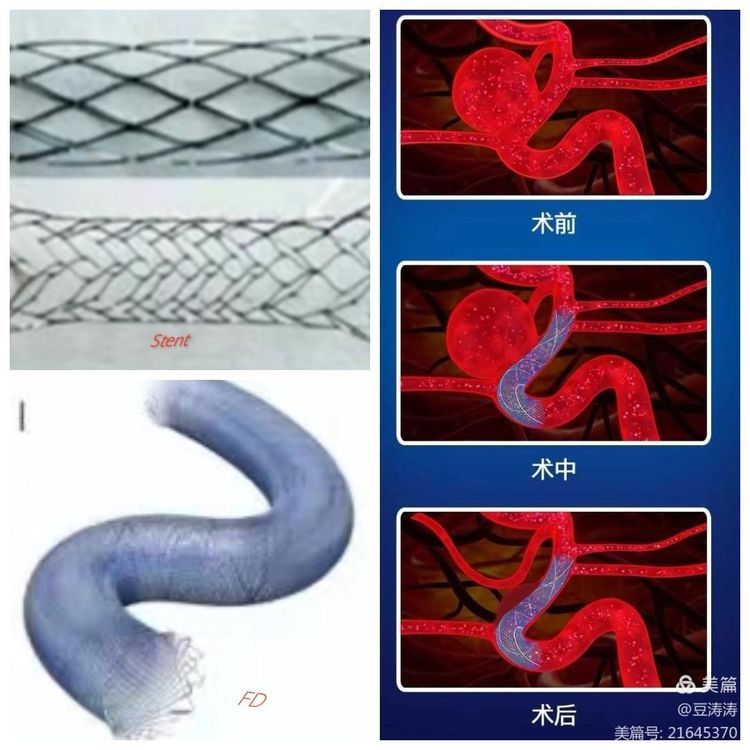 特色展示之九-血流导向装置在颅内复杂动脉瘤中的应用 特色展示之九-血流导向装置在颅内复杂动脉瘤中的应用