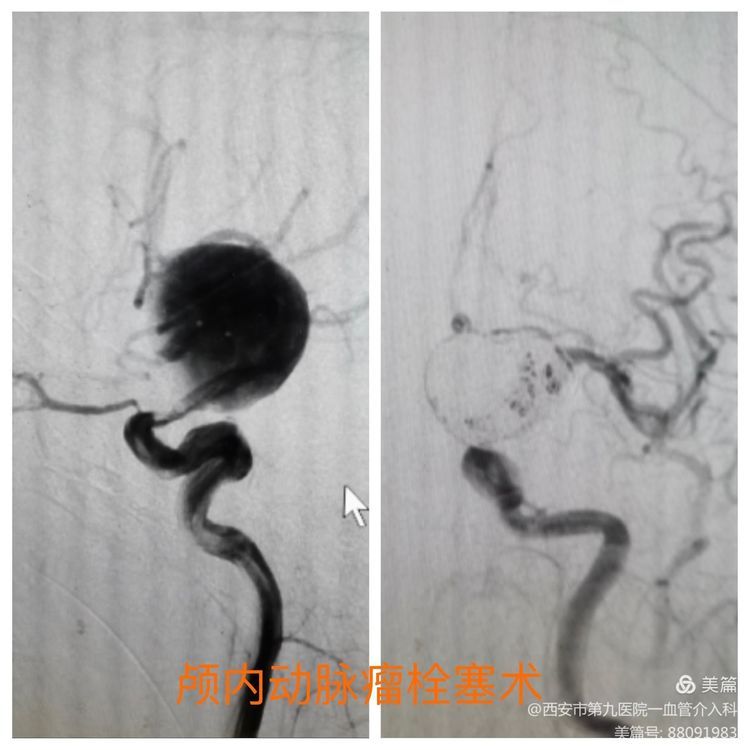 【血管介入科 】介入术中耗材保护的创新与临床应用 【血管介入科 】介入术中耗材保护的创新与临床应用