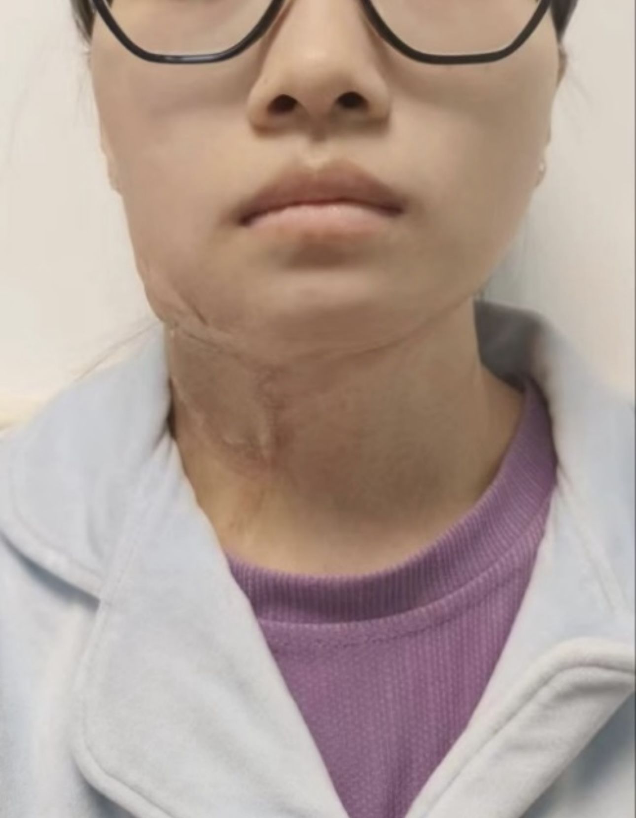 市九院烧伤整形美容科完成“预扩张肩胛皮瓣游离移植修复颈部瘢痕挛缩畸形”一例 市九院烧伤整形美容科完成“预扩张肩胛皮瓣游离移植修复颈部瘢痕挛缩畸形”一例
