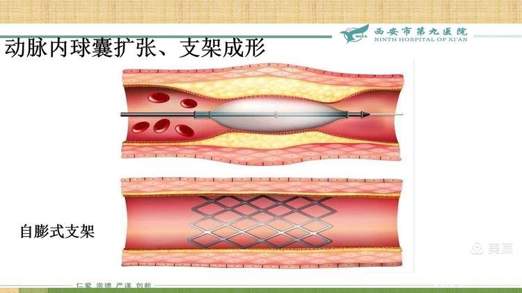 【特色技术】神经外科——球囊扩张及支架成形术治疗颅内动脉粥样硬化性狭窄(ICAS) 【特色技术】神经外科——球囊扩张及支架成形术治疗颅内动脉粥样硬化性狭窄(ICAS)