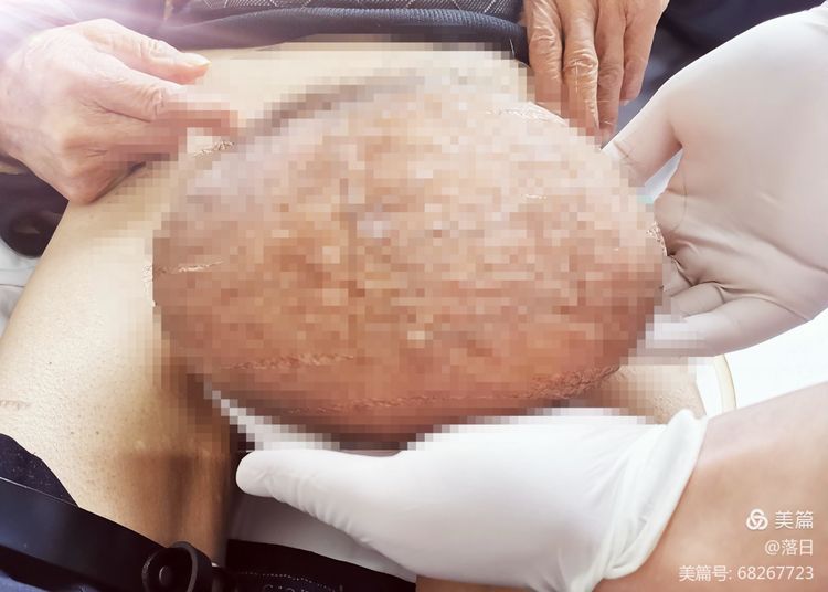 泌尿外科进行一腹股沟巨大疝修补术 泌尿外科进行一腹股沟巨大疝修补术