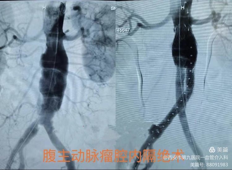 【血管介入科 】介入术中耗材保护的创新与临床应用 【血管介入科 】介入术中耗材保护的创新与临床应用