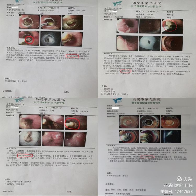 网篮在异物取出术中的应用 网篮在异物取出术中的应用