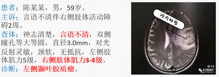 弥散张量成像在胶质瘤术中的应用 弥散张量成像在胶质瘤术中的应用