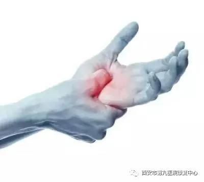 腕管综合征的康复治疗 腕管综合征的康复治疗