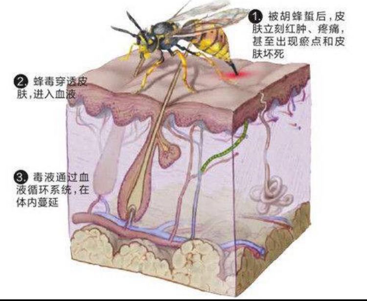 蜂蜇伤不可小觑 蜂蜇伤不可小觑