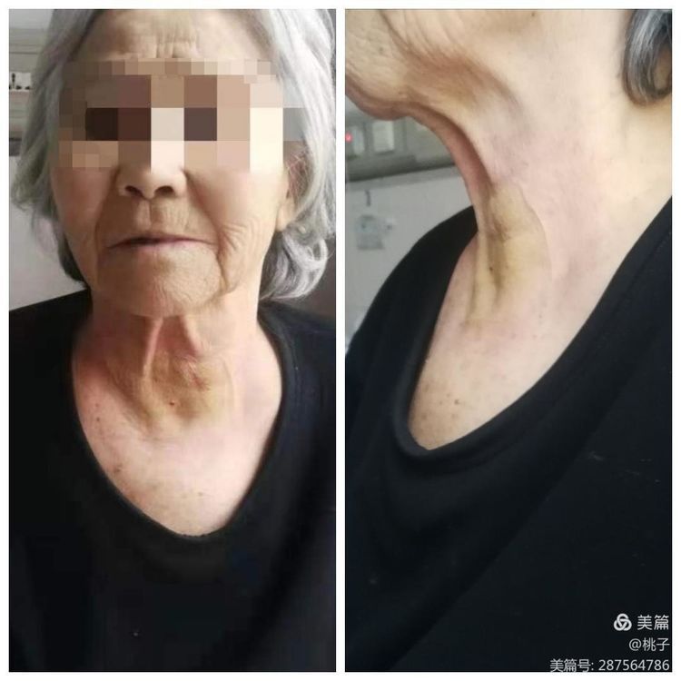 西安市第九医院胸外科甲状腺乳腺组为一名76岁聋哑女性行甲状腺微波消融术 西安市第九医院胸外科甲状腺乳腺组为一名76岁聋哑女性行甲状腺微波消融术