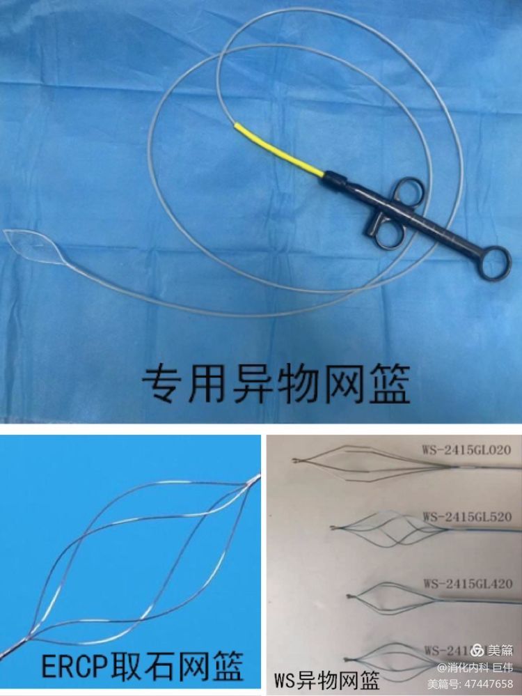 网篮在异物取出术中的应用 网篮在异物取出术中的应用