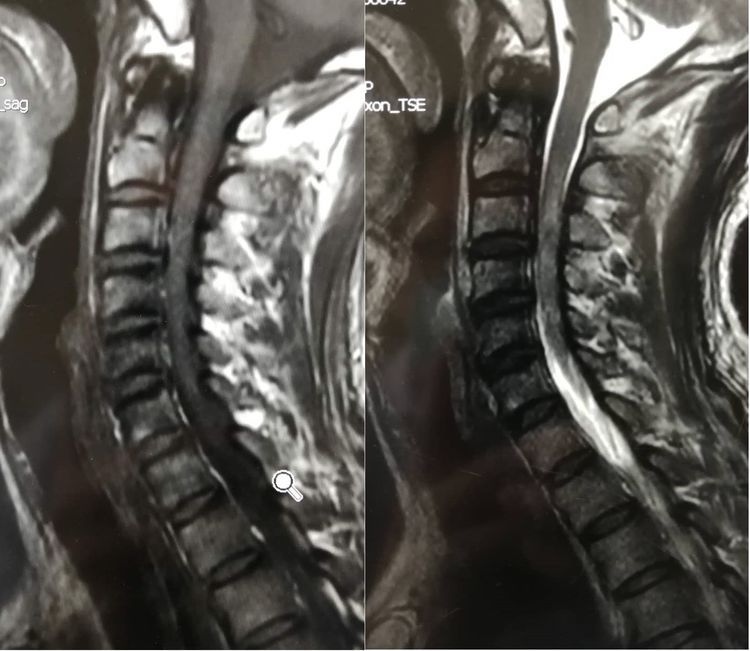 骨科救治一例颈髓损伤患者 骨科救治一例颈髓损伤患者