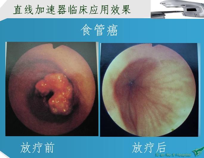 西安市第九医院放疗科开展放射治疗讲座 西安市第九医院放疗科开展放射治疗讲座