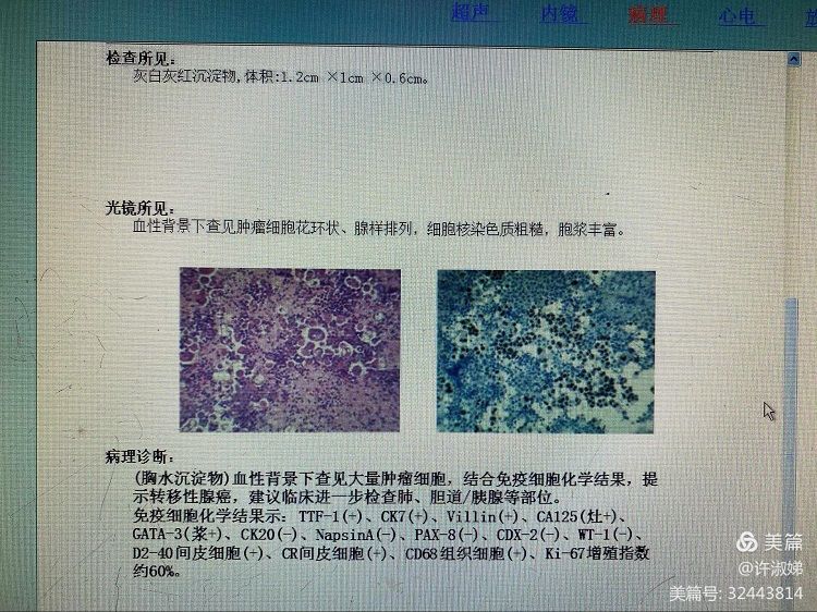 【医疗技术】88岁得了肺癌就只能放弃治疗了吗?非也 【医疗技术】88岁得了肺癌就只能放弃治疗了吗?非也