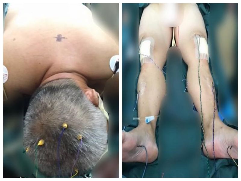 【神经肿瘤】神经电生理监测下切除椎管内肿瘤 【神经肿瘤】神经电生理监测下切除椎管内肿瘤