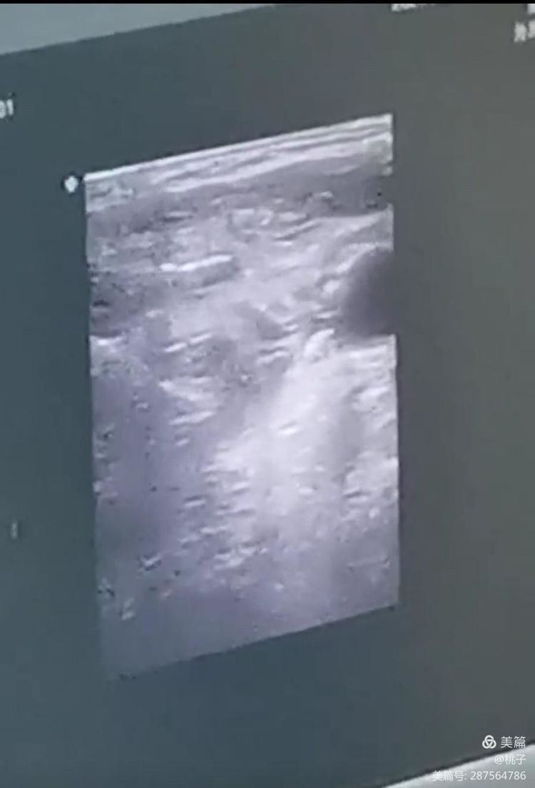 西安市第九医院胸外科甲状腺乳腺组为一名76岁聋哑女性行甲状腺微波消融术 西安市第九医院胸外科甲状腺乳腺组为一名76岁聋哑女性行甲状腺微波消融术
