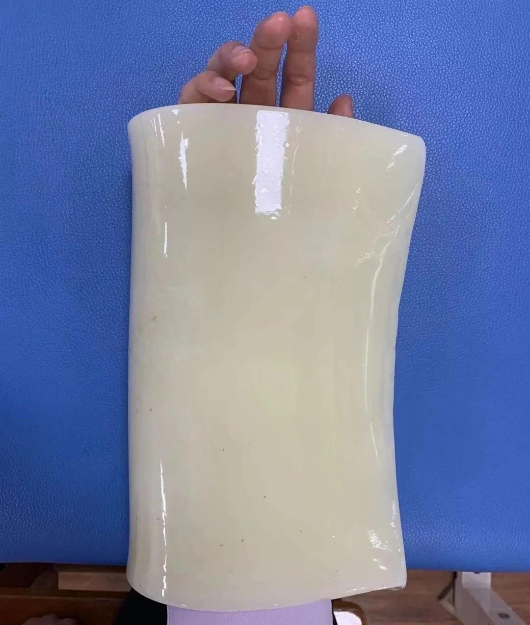 腕管综合征的康复治疗 腕管综合征的康复治疗
