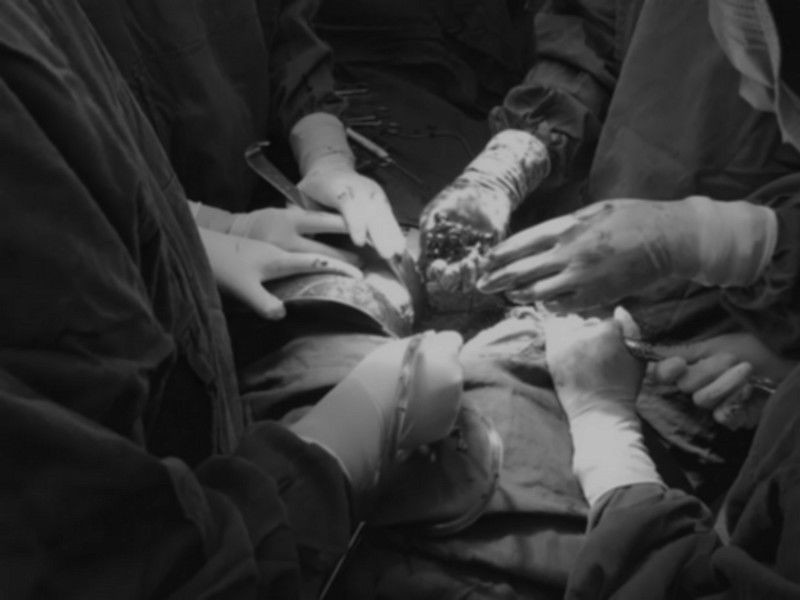 泌尿外科与多学科合作成功切除巨大腹膜后肿瘤 泌尿外科与多学科合作成功切除巨大腹膜后肿瘤