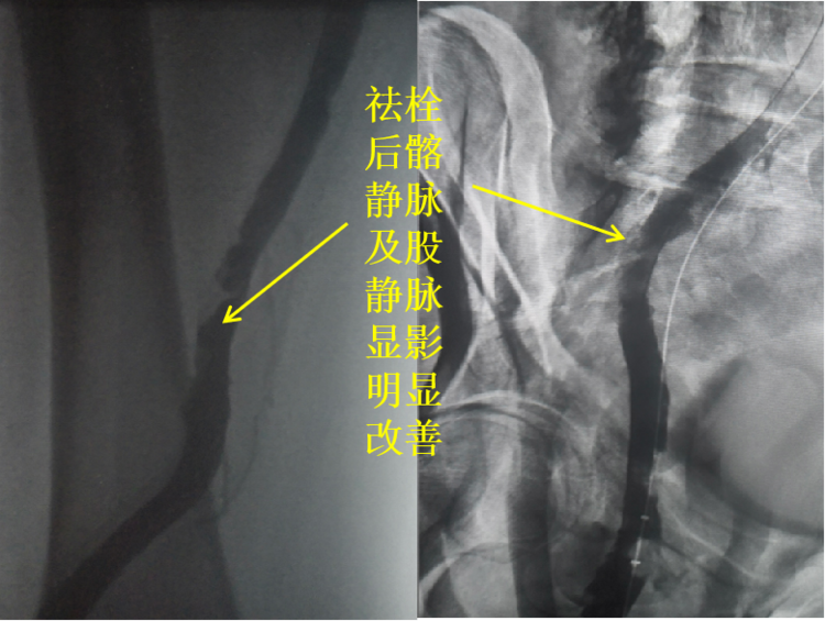 血管介入科开展“Angiojet机械祛栓术”救治一例Cockett综合征伴下肢深静脉血栓患者 血管介入科开展“Angiojet机械祛栓术”救治一例Cockett综合征伴下肢深静脉血栓患者