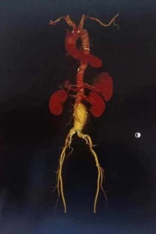 血管介入科完成一例腹主动脉瘤腔内修复术 血管介入科完成一例腹主动脉瘤腔内修复术