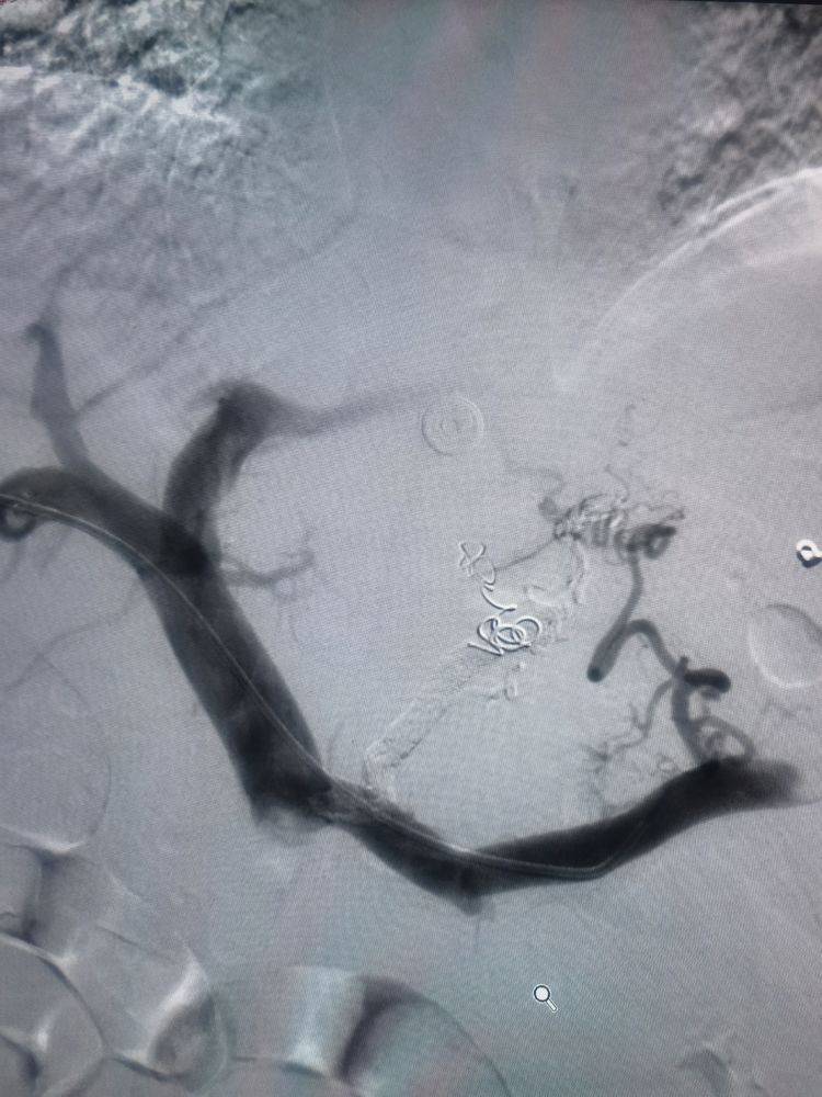 血管介入科救治一例肝硬化所致上消化道大出血患者 血管介入科救治一例肝硬化所致上消化道大出血患者