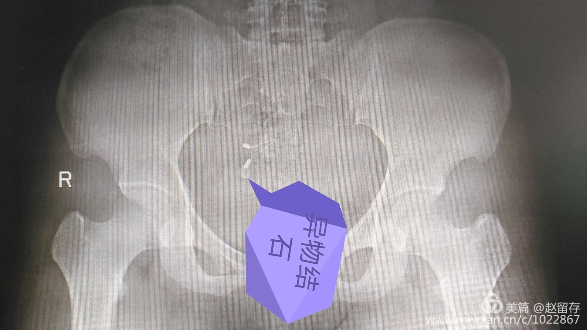 泌尿外科双镜联合治疗特殊膀胱结石 泌尿外科双镜联合治疗特殊膀胱结石
