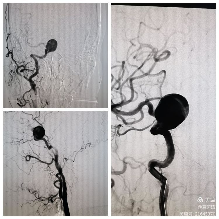 特色展示之九-血流导向装置在颅内复杂动脉瘤中的应用 特色展示之九-血流导向装置在颅内复杂动脉瘤中的应用