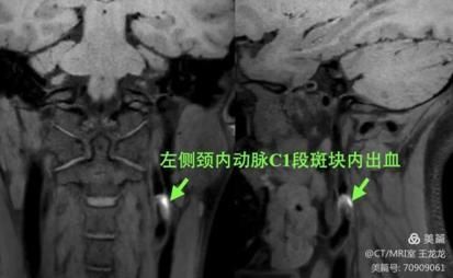 血管壁高分辨成像在头颈部血管斑块的危险性评估应用 血管壁高分辨成像在头颈部血管斑块的危险性评估应用